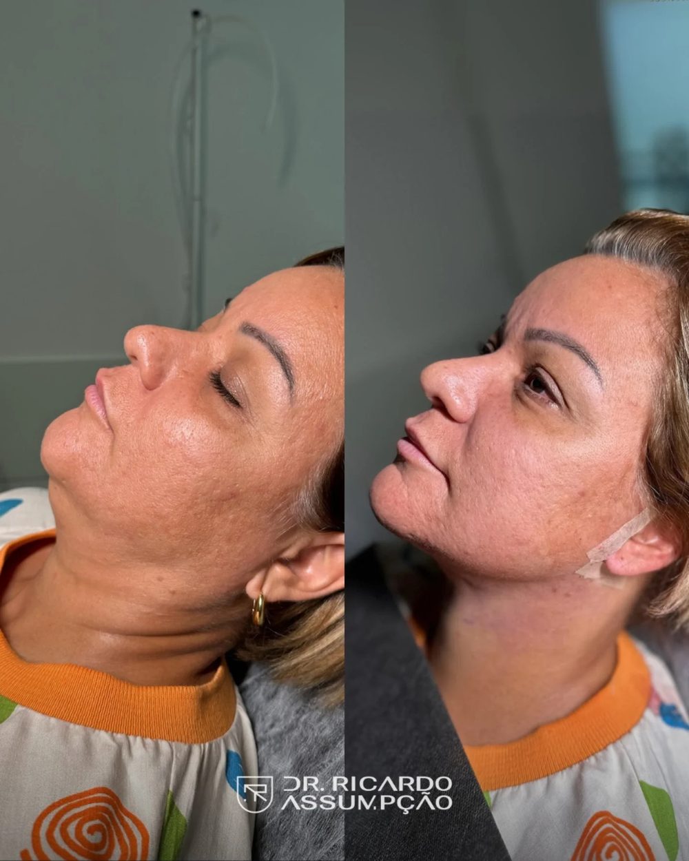 Antes e depois — paciente do Dr. Ricardo Assumpção