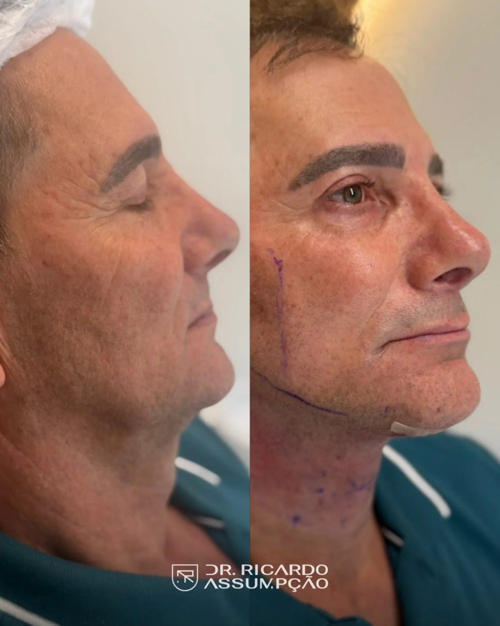 Antes e depois — paciente do Dr. Ricardo Assumpção