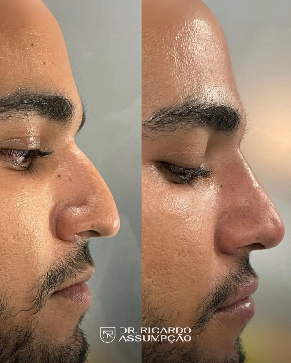 Antes e depois — paciente do Dr. Ricardo Assumpção