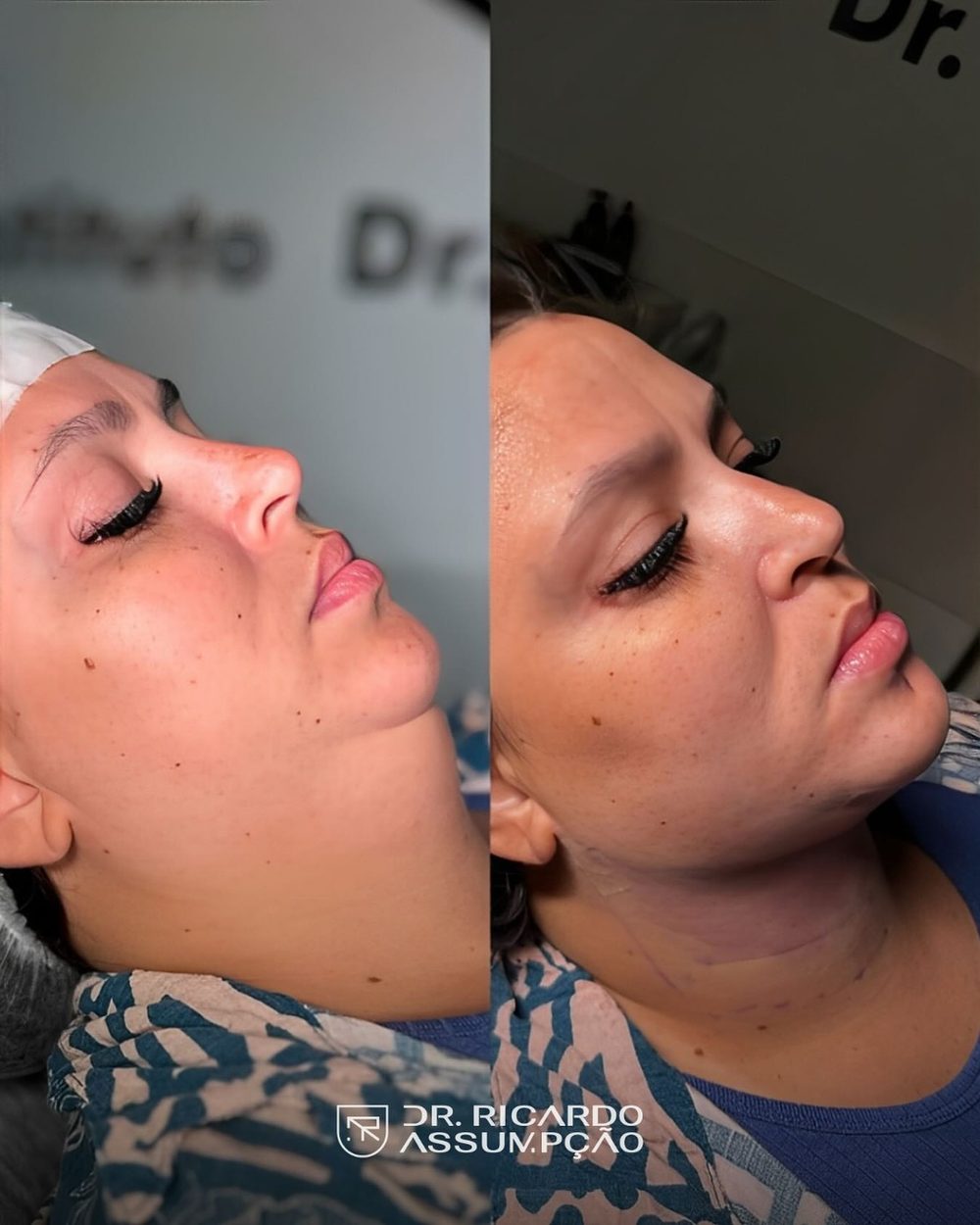Antes e depois — paciente do Dr. Ricardo Assumpção