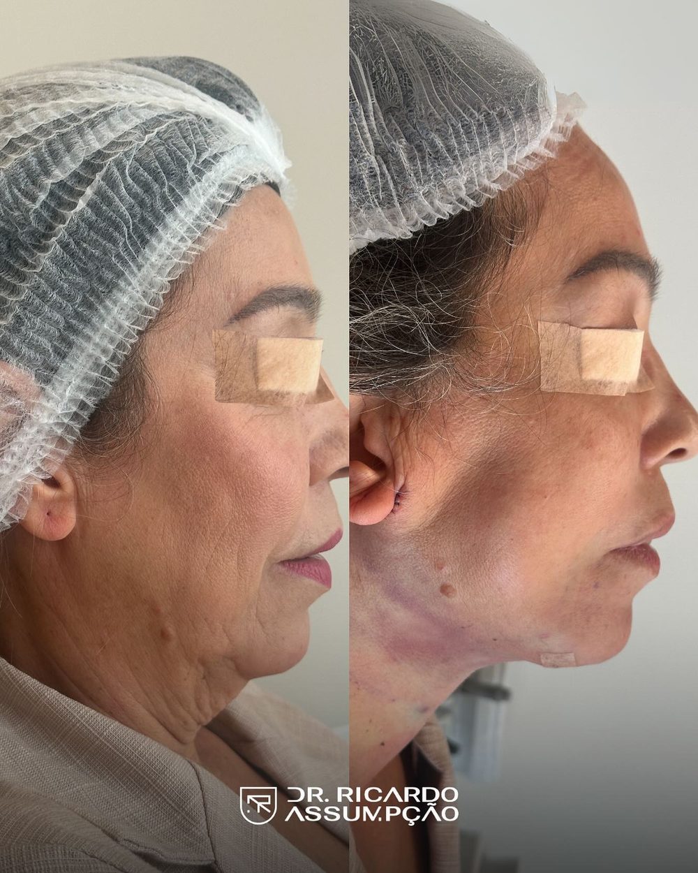Antes e depois — paciente do Dr. Ricardo Assumpção