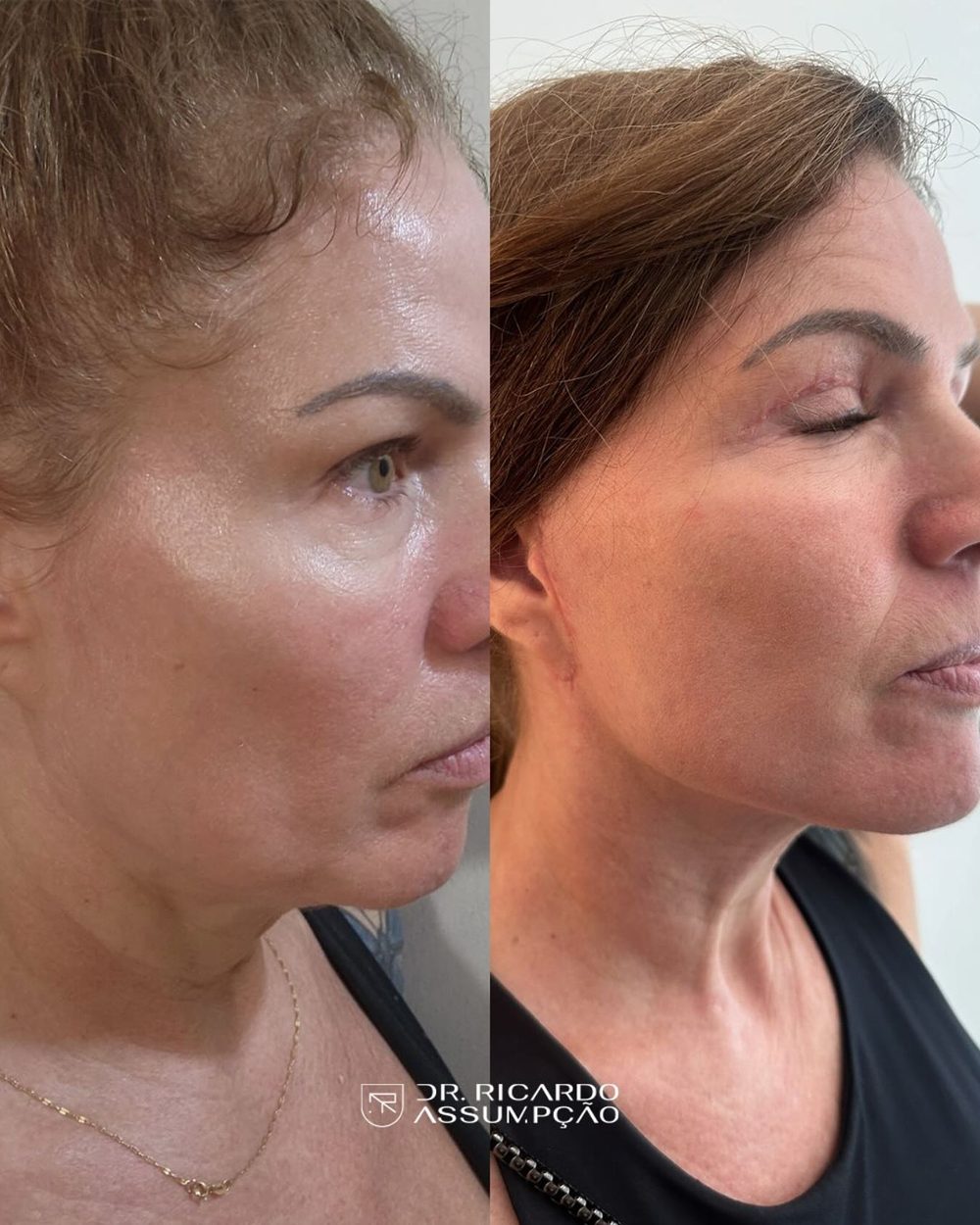 Antes e depois — paciente do Dr. Ricardo Assumpção
