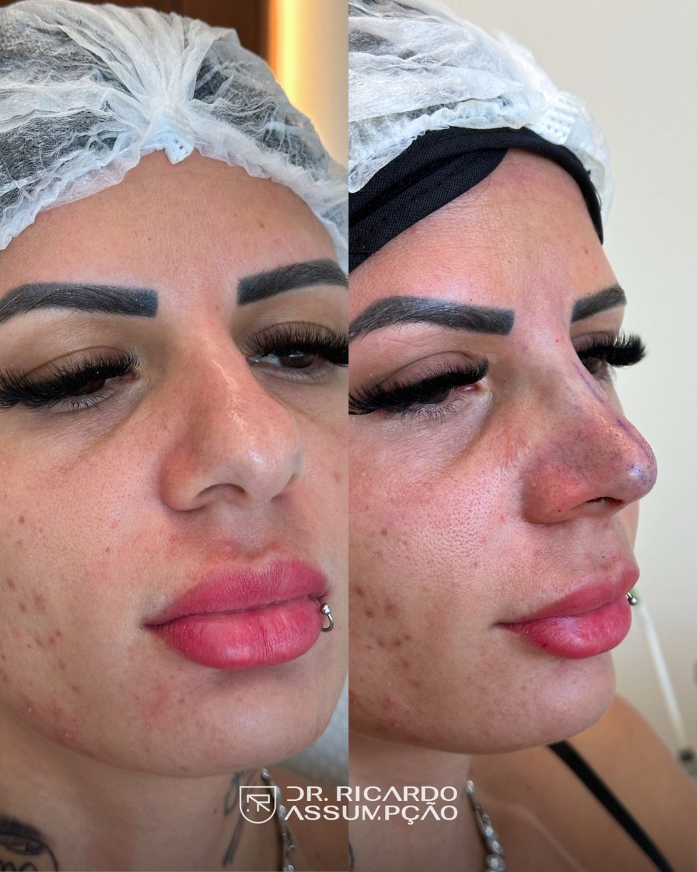 Antes e depois — paciente do Dr. Ricardo Assumpção